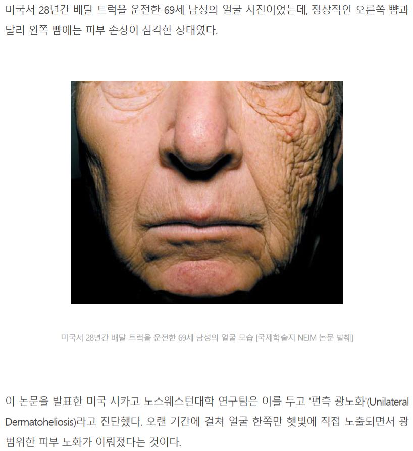 FireShot Capture 036 - 자외선 노출이 부른 트럭 운전기사의 ',두 얼굴', _ 동아사이언스 - www.dongascience.com.png.jpg